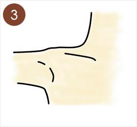 3.わきを90度くらいに開いた状態で手術を行います。