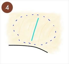 4.わきの毛の範囲をマーキング。わきの中央を切開するデザイン。切開部分およびマーキングした部に局所麻酔注射する。