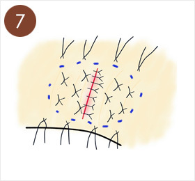 7.汗の腺を除去した皮ふをもとにもどして皮ふが下にくっつくように糸で縫合する。周囲に傷の圧迫のためのガーゼを固定する糸をつける。