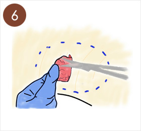 6.皮ふをひっくり返して汗の腺をハサミで切除する。