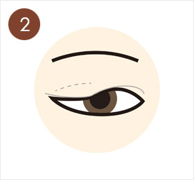 2.眼瞼下垂：まぶたを開ける筋肉の働きが弱いため、開けずらい。まぶたの皮ふがたるんで目に重なる。黒目にかぶさりみえずらい。