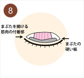 8.まぶたを開ける筋肉の付着部とまぶたの硬い板まで到達する。