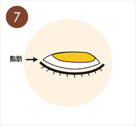 7.重く突出した脂肪がある場合は、一部の脂肪を切除する。